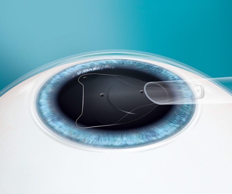 Lenti Intraoculari Icl3A Una So