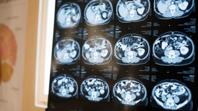 Ema Approva Lecanemab3A Una Nuo