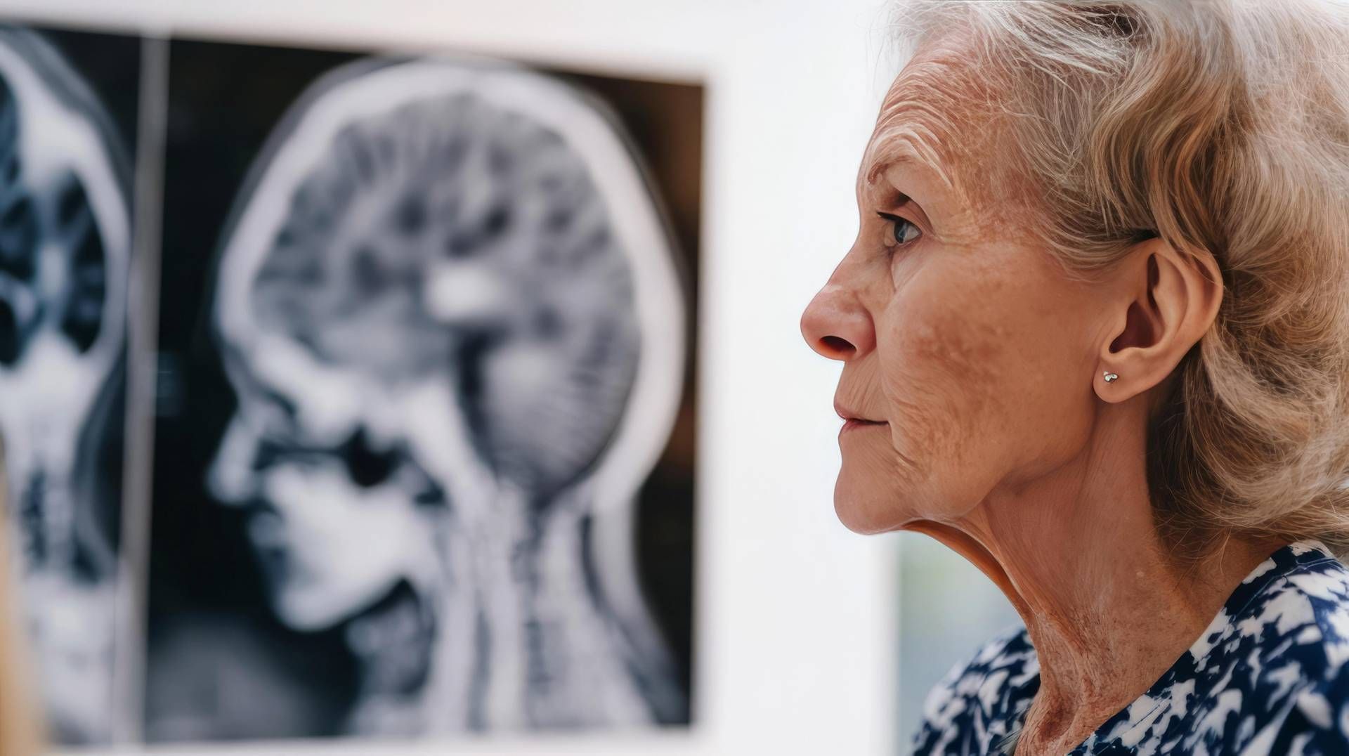 Salute Neurologica Femminile: Le Sfide del 2025 e l'Importanza di una Diagnosi Precoce