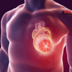 Screening Amiloidosi Cardiaca Nella Marsica: La Asl 1 Abruzzo Coinvolge 200 Persone A Rischio