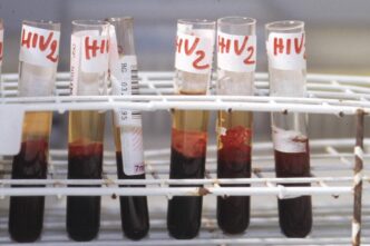 L27Aids Torna A Colpire3A Tagli