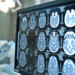 L’esperienza Dell’asl Di Salerno Con Il Progetto Telestroke: Hub E Spoke Per La Diagnosi Dell’ictus