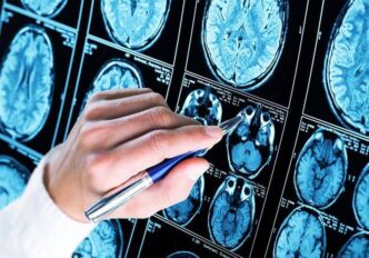 Donanemab3A Nuova Terapia Per R