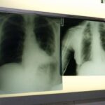 Triplice Terapia Per Bpco Con Nuovo Propellente A Basso Impatto Ambientale Ottiene Via Libera In Europa