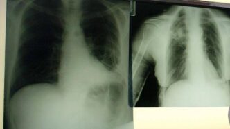 Triplice Terapia Per Bpco Con