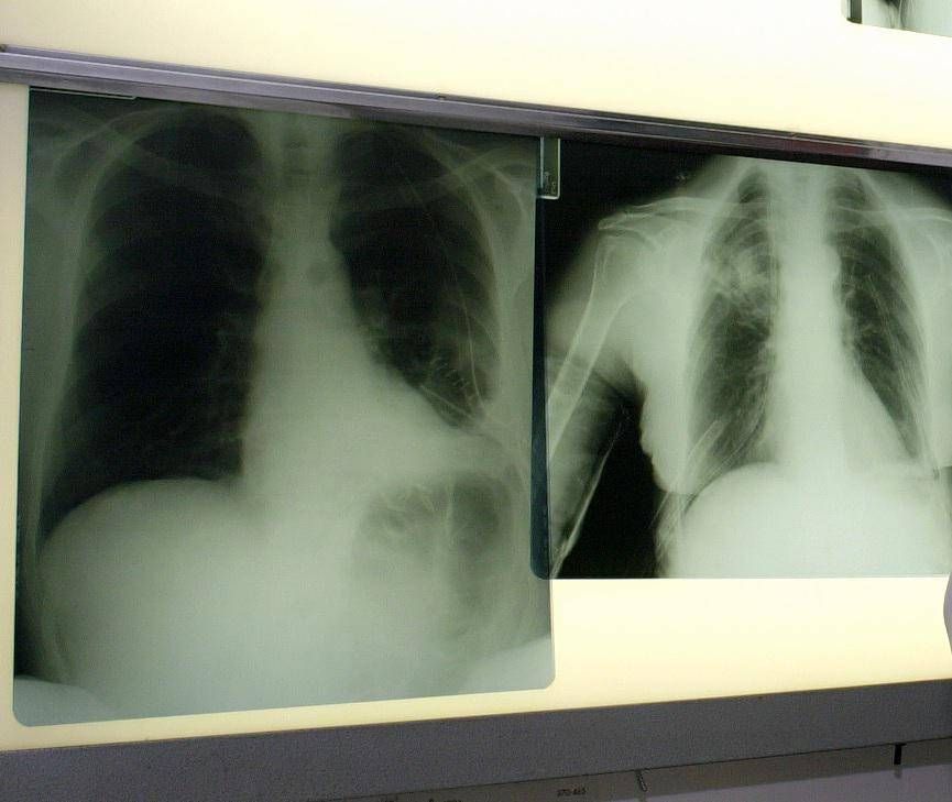 Triplice Terapia Per Bpco Con