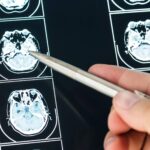 Un Algoritmo Per Prevedere L’evoluzione Del Morbo Di Parkinson Grazie All’intelligenza Artificiale